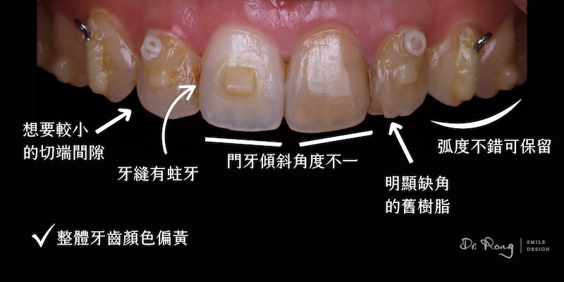 完成矯正後的牙齒狀況，仍有牙齒黃、蛀牙、齒色不均與樹脂補綴缺角等問題，影響整體笑容自然度