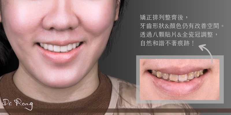 陶瓷貼片療程後的笑容，呈現自然透亮的齒色與和諧比例