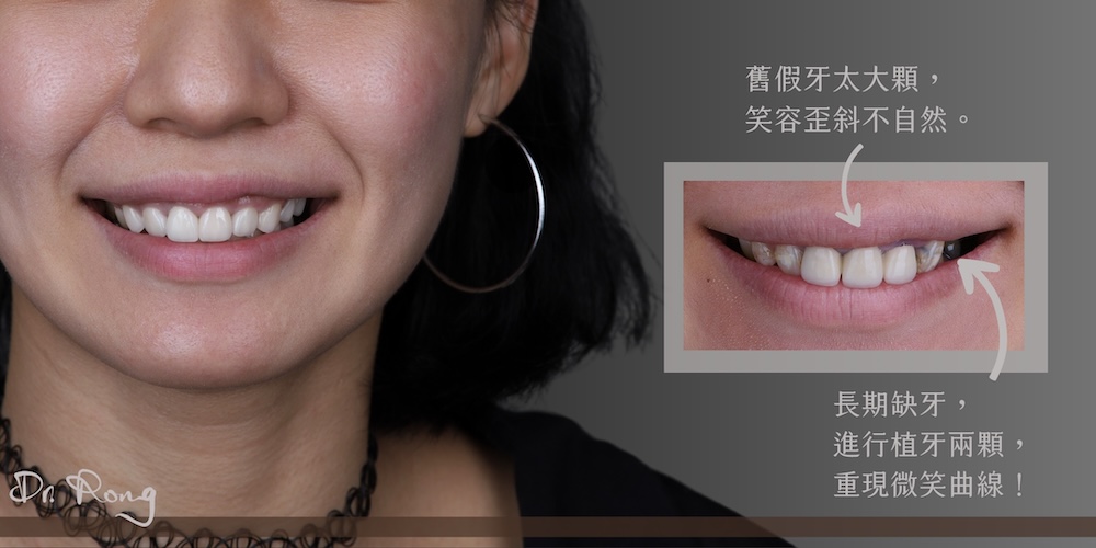 假牙牙齦黑-假牙重做-全瓷冠-瓷牙貼片-香港-推薦-台北-許家榕醫師