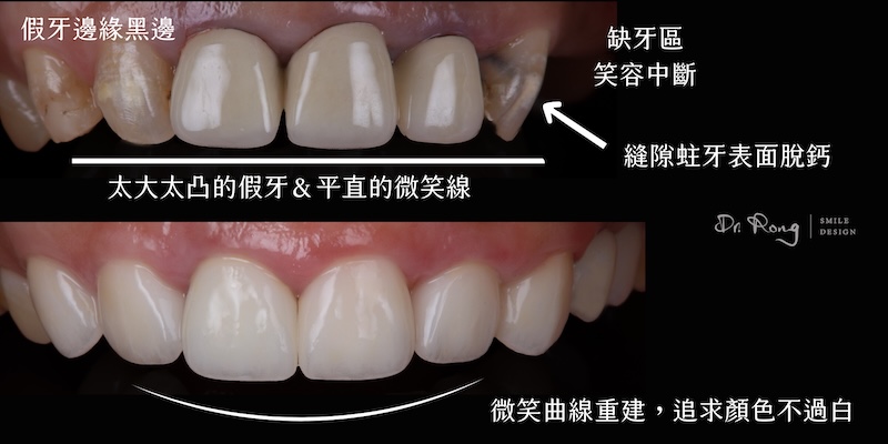 舊假牙邊緣黑、形狀太凸且微笑線平直；透過全瓷冠與瓷牙貼片重建自然微笑曲線