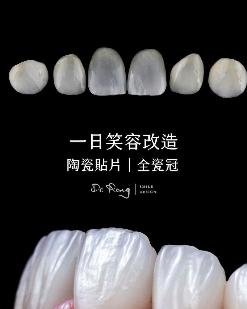 前牙美學療程-一日笑容改造
