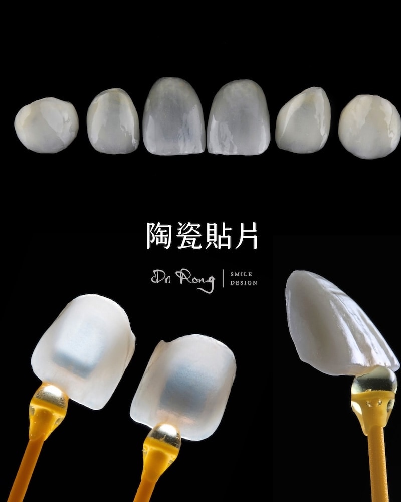 前牙美學療程-陶瓷貼片