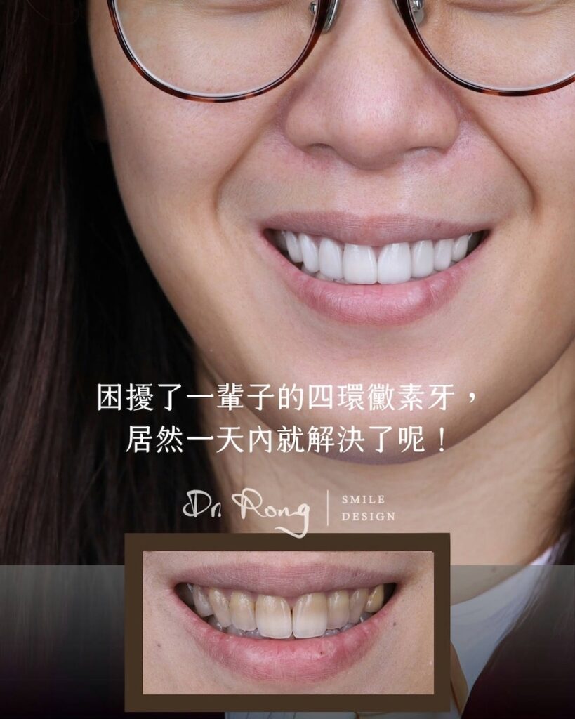 患者因四環黴素染色造成牙齒灰黃且帶有暗色條紋，經陶瓷貼片與全瓷冠混合修復後，笑容明亮自然、提升整體自信
