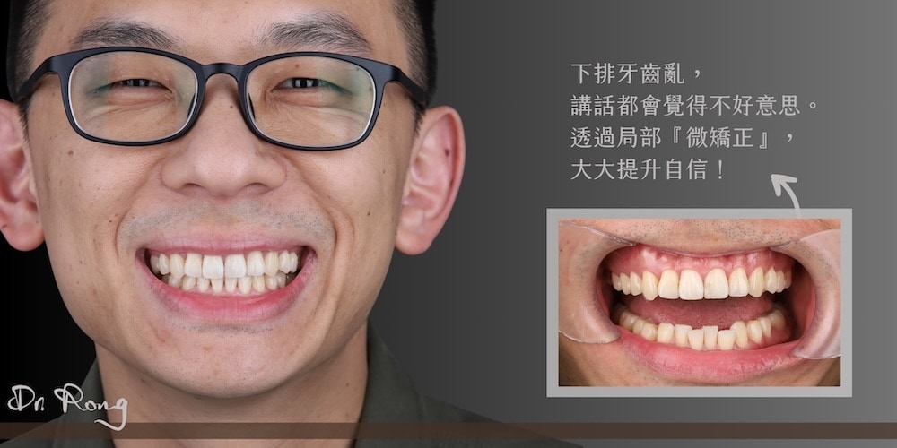 牙齒亂-微矯正-全瓷冠-冷光美白-大頭哥哥-推薦-台北-許家榕醫師