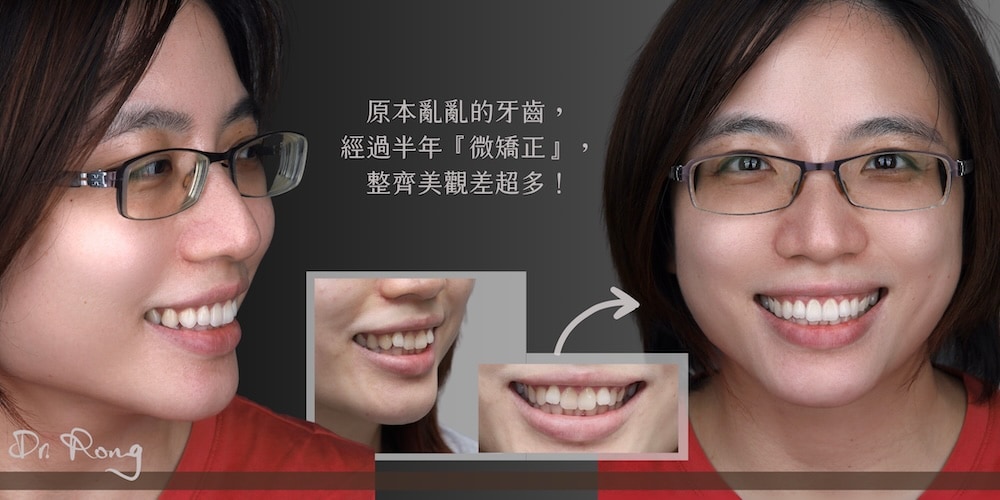 牙齒亂-微矯正-牙齒微矯正-推薦-台北-許家榕醫師