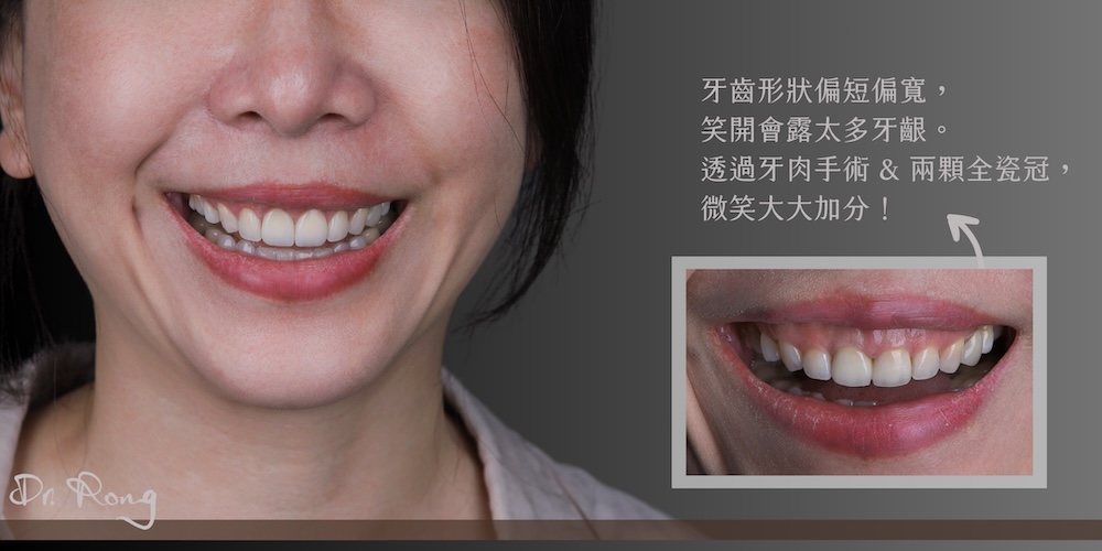 牙齒短-笑露牙齦-牙冠增長術-全瓷冠-推薦-台北-許家榕醫師