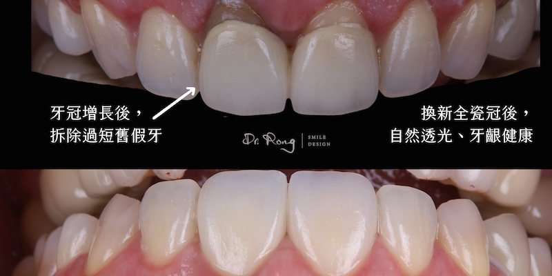 牙冠增長術前牙齒過短，拆除舊假牙換上自然透光的全瓷冠，牙齦健康、外觀自然