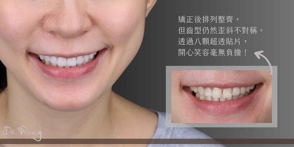 矯正後仍有牙齒歪斜不對稱，經陶瓷貼片微調齒列比例與外型，笑容更對稱柔和