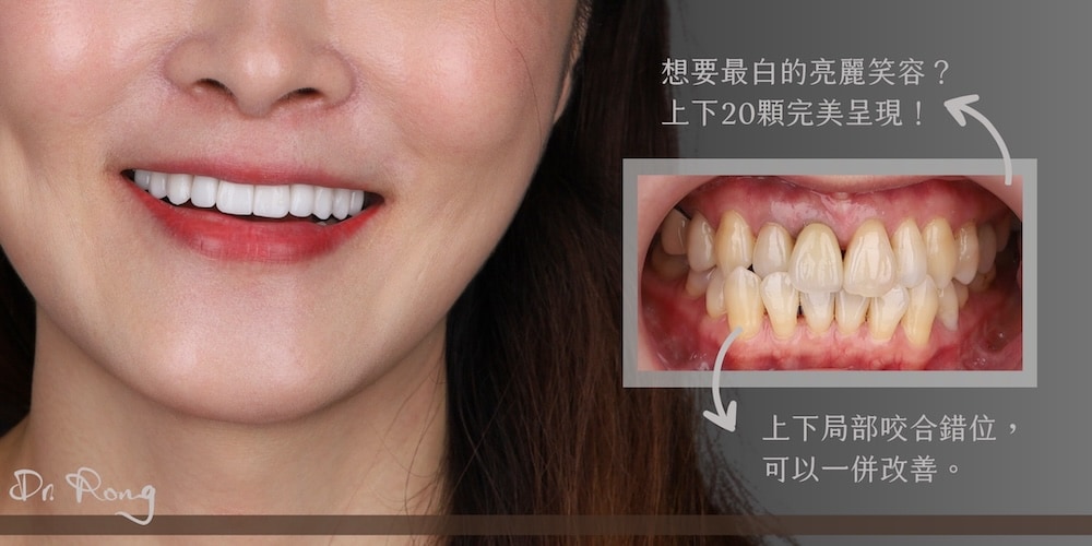 患者原牙齒泛黃且局部咬合錯位，經陶瓷貼片修復後，牙齒整齊潔白，笑容更加協調自然