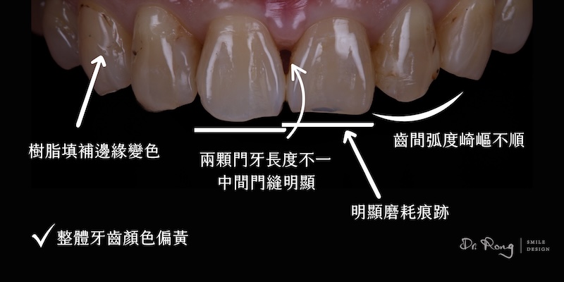 陶瓷貼片術前牙齒排列與顏色問題，包括牙齒黃、門牙縫大、補牙變色等