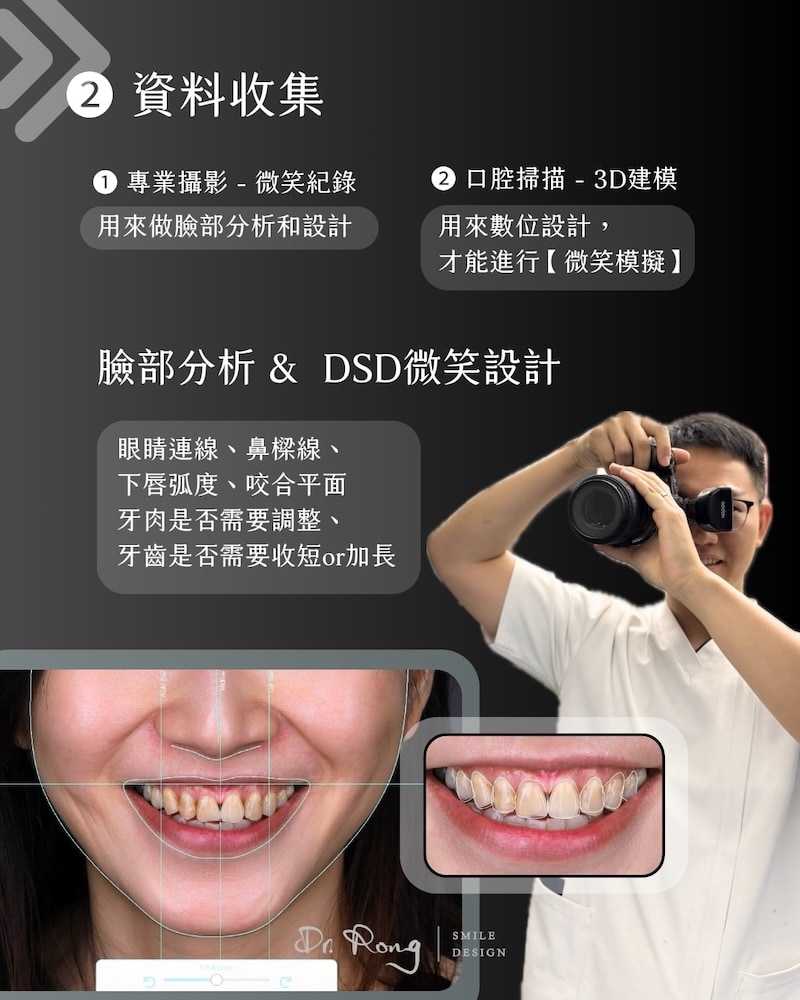 笑容改造流程-2-資料收集與DSD微笑設計