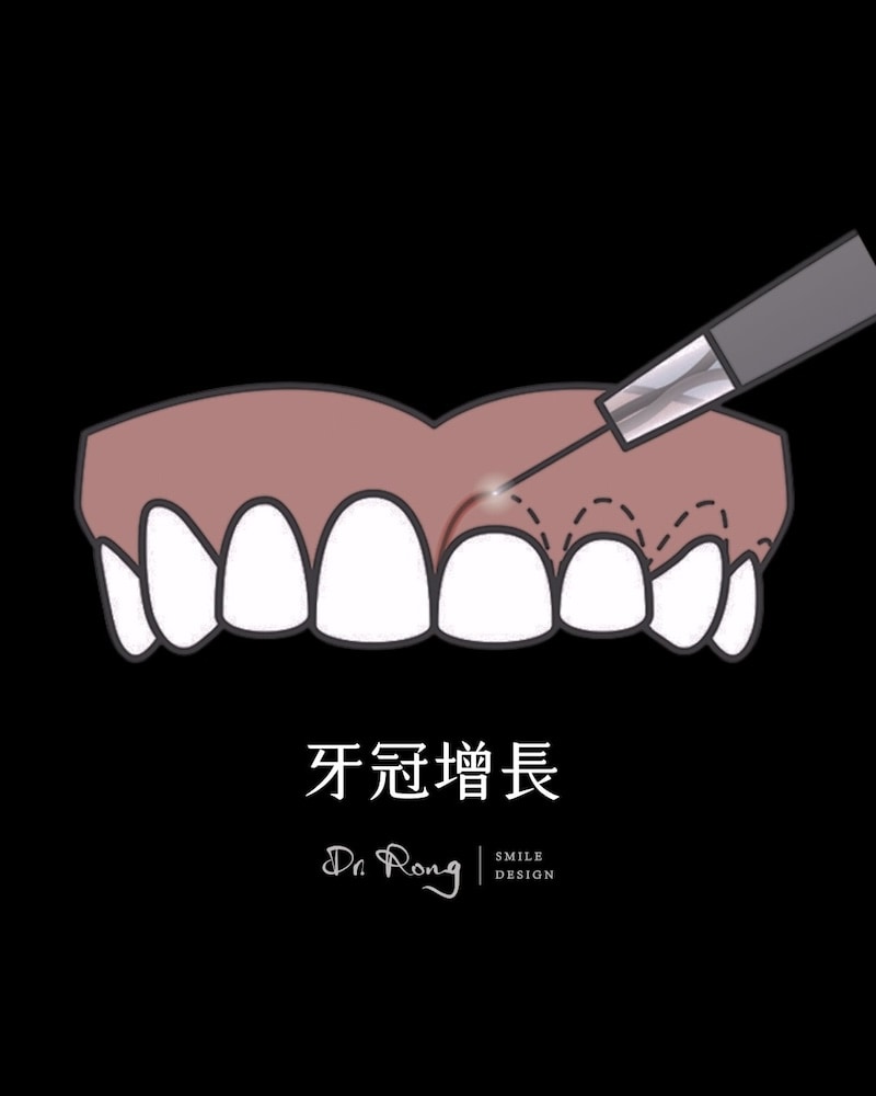 輔助牙科美容療程-牙冠增長術