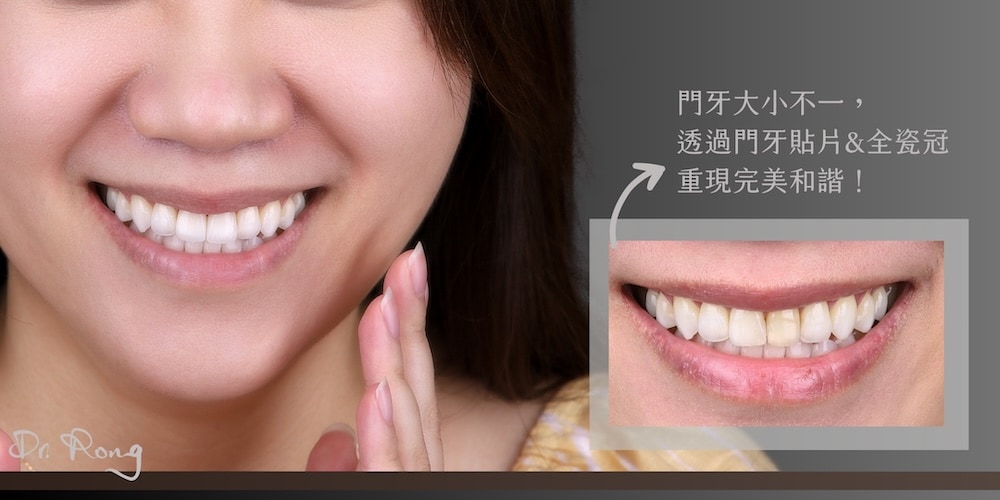患者門牙原本大小不一影響整體協調，經陶瓷貼片與全瓷冠重塑後，牙齒比例整齊、笑容更對稱自然