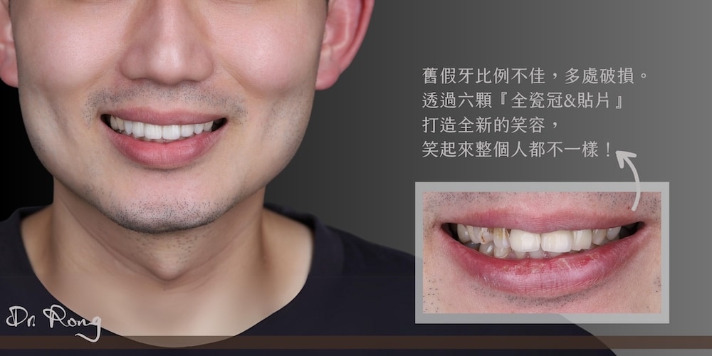 原有假牙破損且比例不佳，經由三顆陶瓷貼片與三顆全瓷冠重建，呈現自然和諧的新笑容