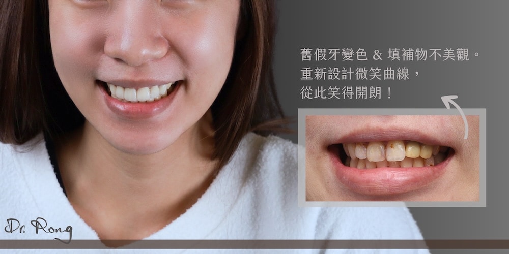 假牙與樹脂補牙變色不美觀，透過微笑設計重建潔白整齊的笑容