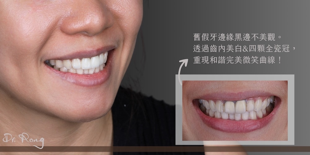 舊假牙邊緣變黑，透過齒內美白與四顆全瓷冠重建自然潔白的笑容