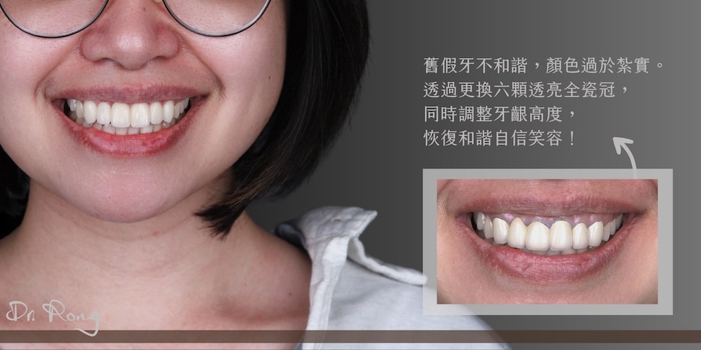 舊假牙色偏黃且邊緣明顯，搭配六顆全瓷冠與牙齦微調，重建自然對稱的笑容