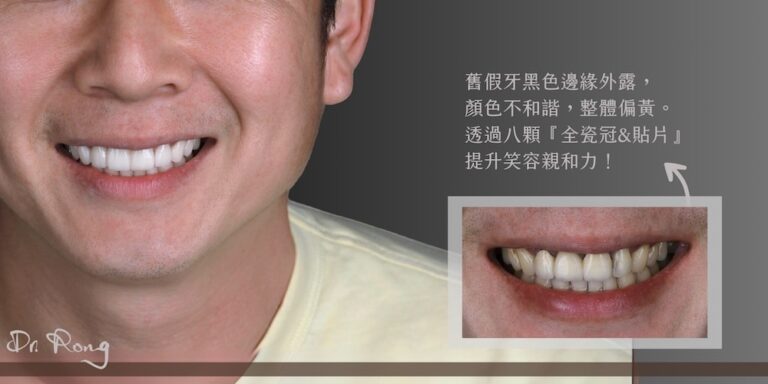 假牙出現黑邊且顏色偏黃，透過八顆全瓷冠與陶瓷貼片打造自然協調的親切笑容