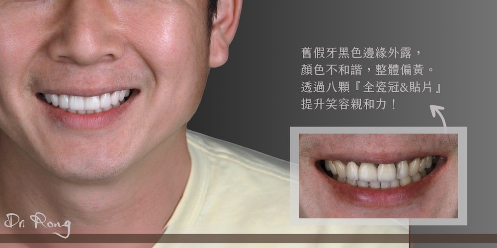 假牙出現黑邊且顏色偏黃，透過八顆全瓷冠與陶瓷貼片打造自然協調的親切笑容