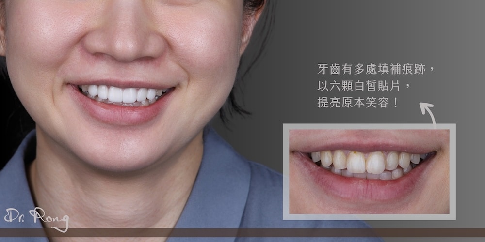 患者因補牙樹脂變色造成色差與痕跡，透過陶瓷貼片修飾齒色與牙齒比例，改善視覺暗沉，笑容自然明亮有精神