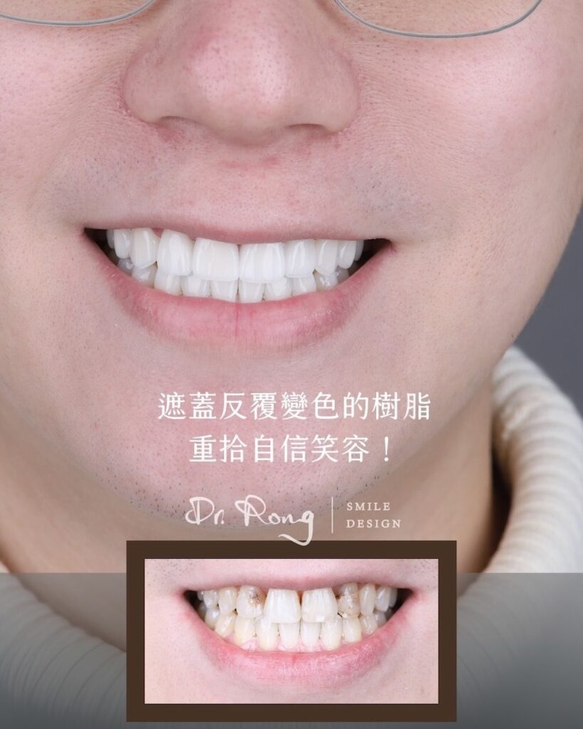 患者因補牙樹脂變色導致笑容有明顯色差，透過陶瓷貼片遮蓋色差、調整形狀，重拾協調自信的笑容