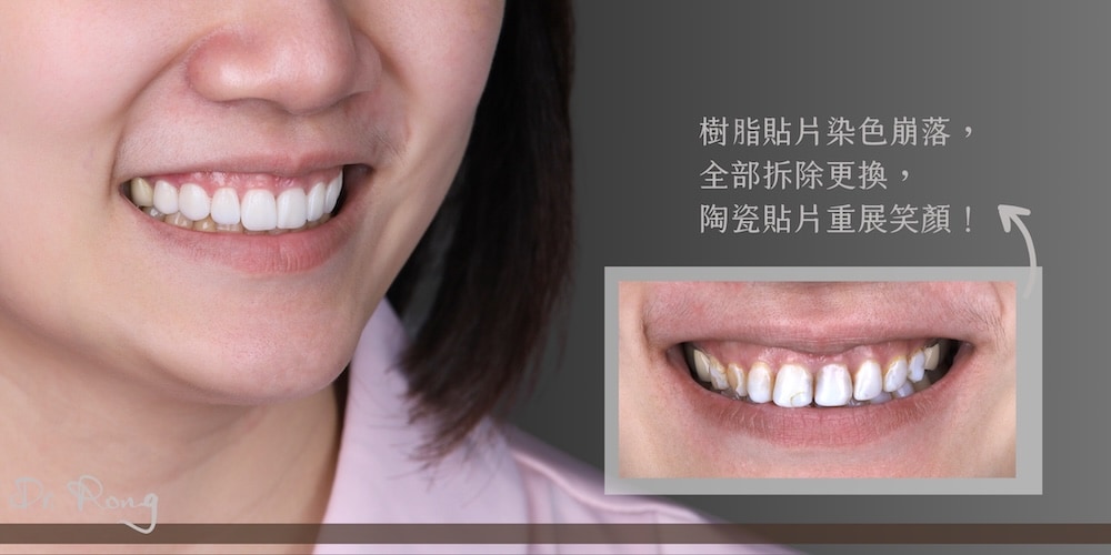 樹脂貼片染色崩落，透過微笑設計與陶瓷貼片、全瓷冠重建自然潔白的笑容
