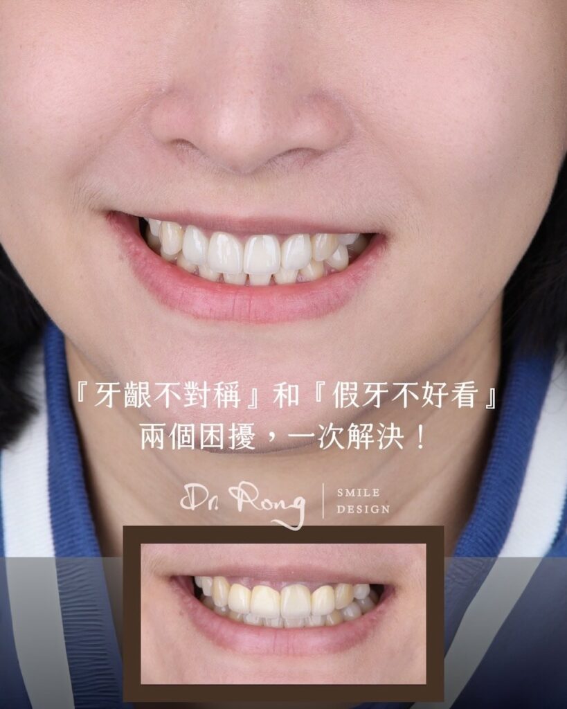 牙齒不對稱與假牙不自然，透過微笑設計重做假牙，重建協調亮白笑容
