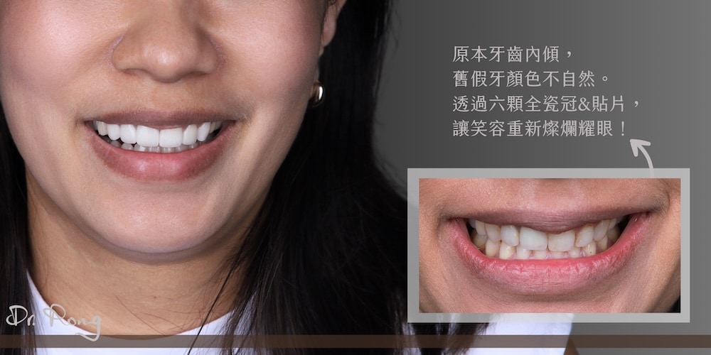 牙齒內傾與假牙顏色不自然，透過六顆全瓷冠與陶瓷貼片重塑自然潔白的笑容