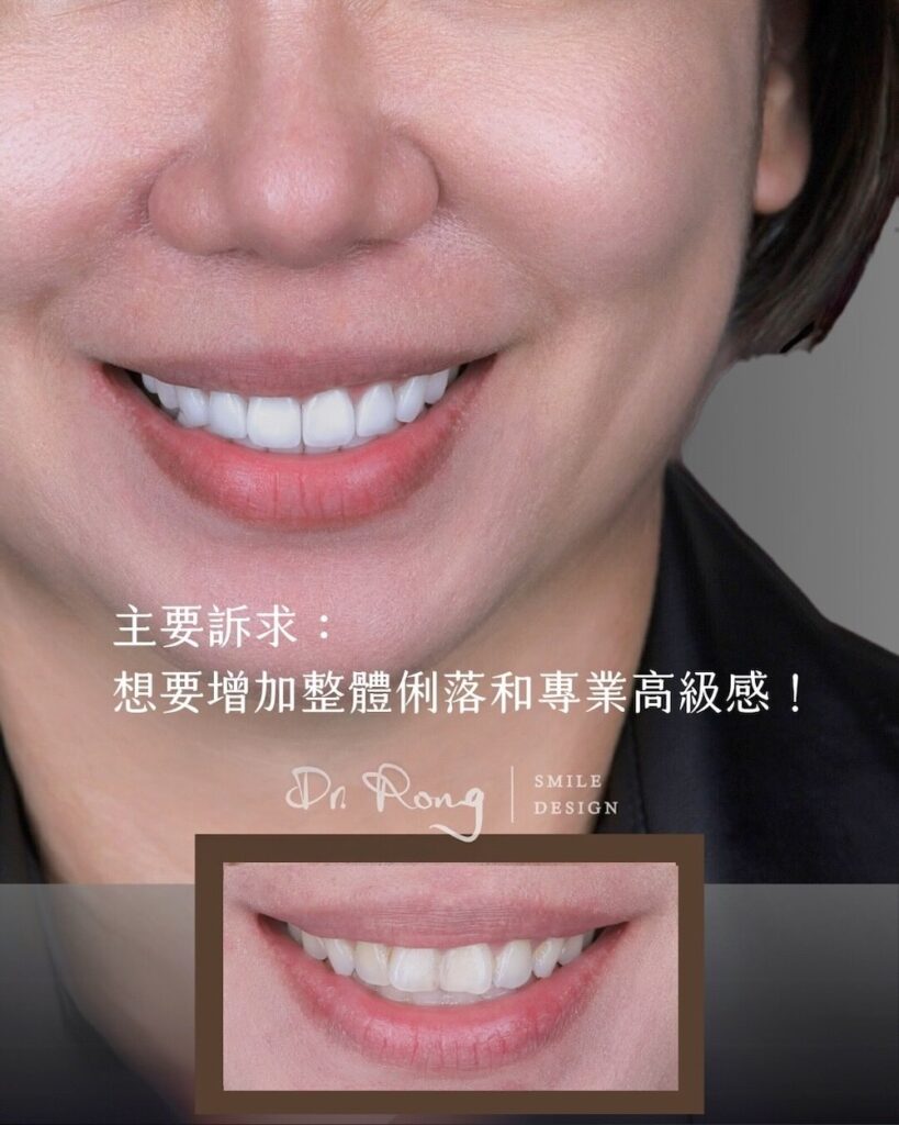 患者有牙齒微亂、牙齒偏黃、微笑線平直等問題，透過陶瓷貼片調整齒色、齒型和微笑線，展現俐落大方的高質感笑容