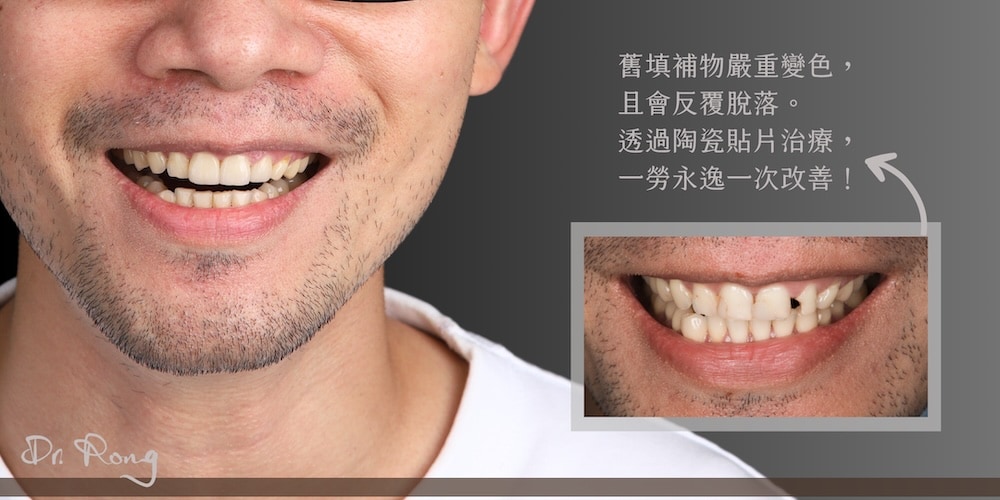 意外咬斷牙齒造成缺一小塊，以樹脂臨時修補，後續再透過陶瓷貼片、全瓷冠全面改善補牙變色且邊緣不順問題，重建自然對稱笑容