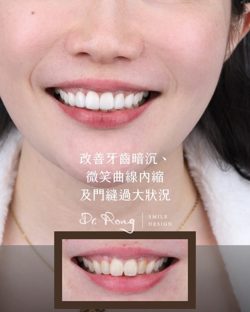 患者的牙齒暗沉與門牙縫隙過大，笑容曲線略顯內縮，透過陶瓷貼片精緻調整牙齒形狀與排列，塑造飽滿自然的微笑線條
