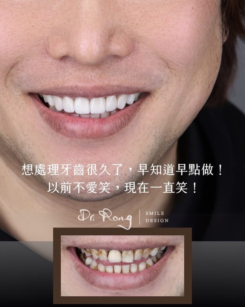 患者原先牙齒染色嚴重且假牙外觀不自然，更換舊假牙搭配陶瓷貼片重建整齊潔白的門面，恢復自然自信笑容