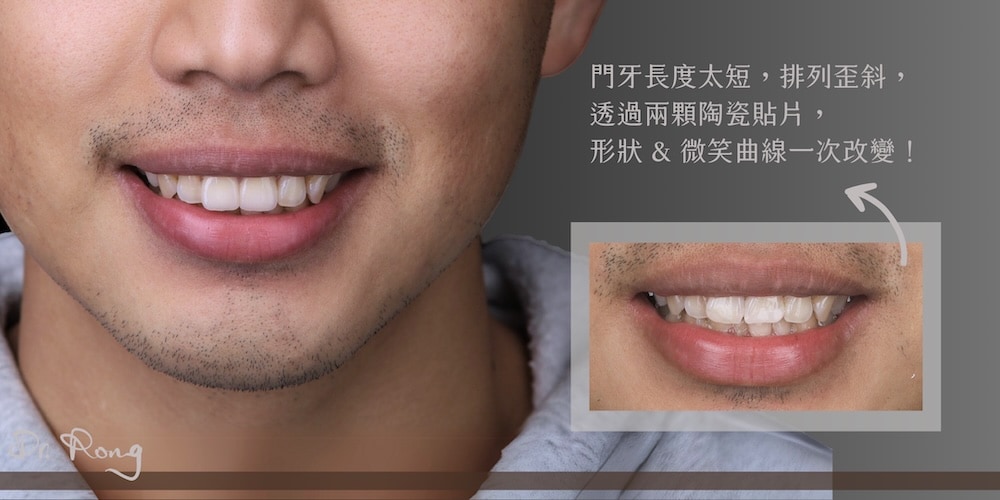 牙齒短小、牙齒顏色不均有補綴痕跡，透過陶瓷貼片修飾齒色與比例，笑容變得自然、協調又自信