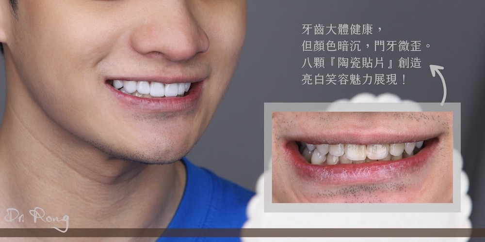 患者因牙齒黃與門牙略微歪斜，經陶瓷貼片調整牙齒比例與色澤，展現整齊亮白的笑容
