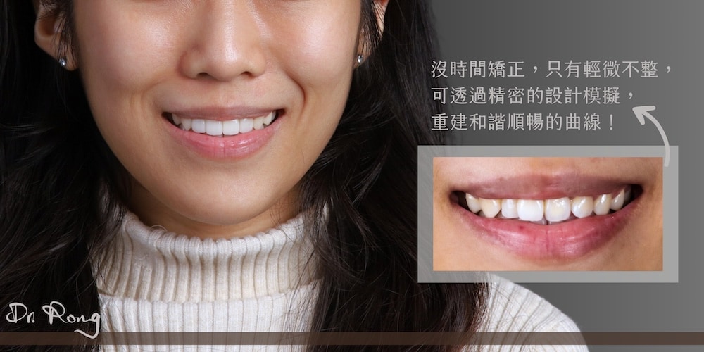 矯正後未認真配戴維持器導致牙齒跑掉，透過陶瓷貼片重建整齊齒列與自然微笑曲線
