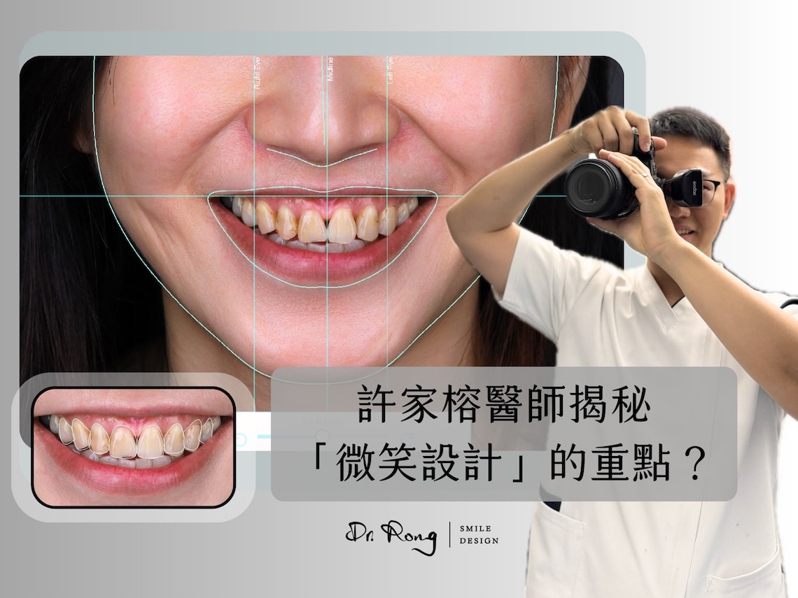 DSD數位微笑設計-台北陶瓷貼片-推薦牙醫-許家榕醫師