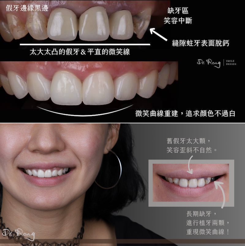 患者原假牙邊緣發黑且凸出，評估後先完成假牙重做與貼片，再以植牙重建缺牙