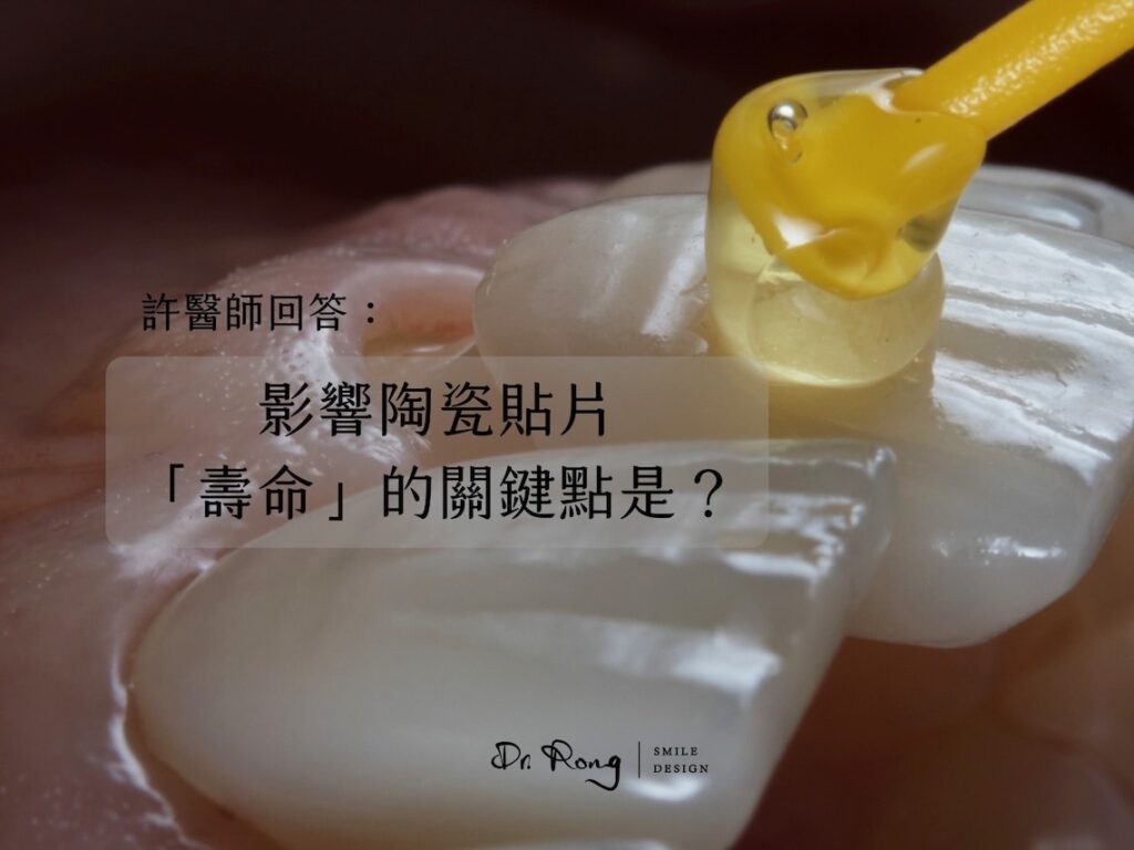 陶瓷貼片壽命-瓷牙貼片-牙齒貼片-牙醫推薦-台北-許家榕醫師