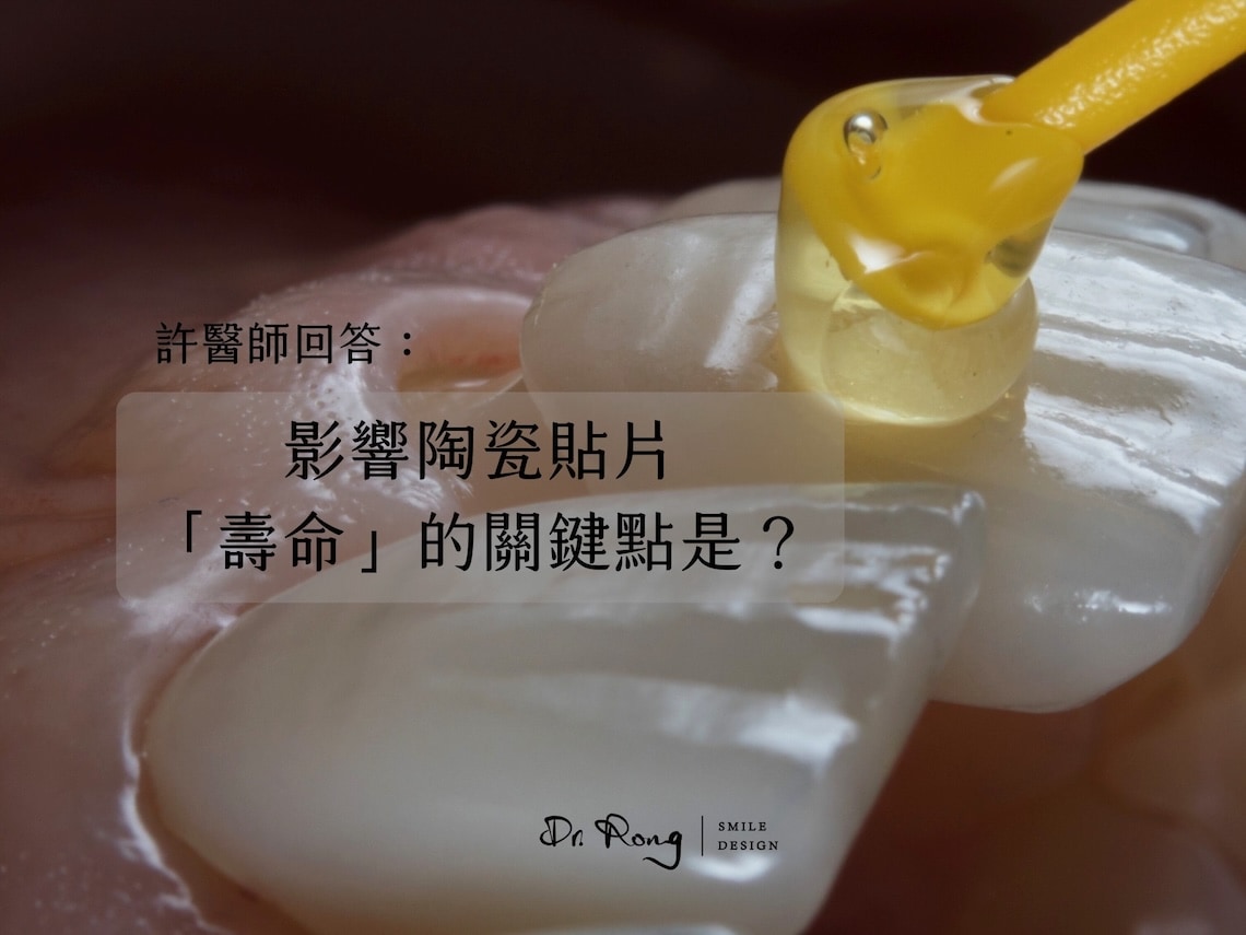陶瓷貼片壽命-瓷牙貼片-牙齒貼片-牙醫推薦-台北-許家榕醫師