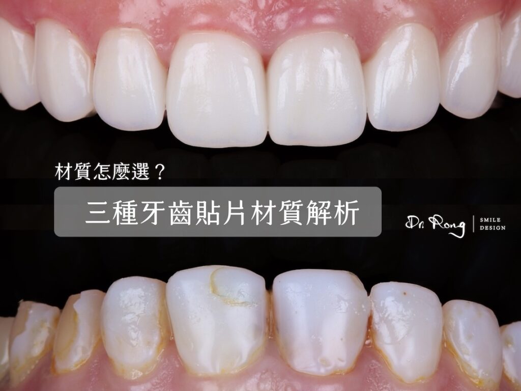 牙齒貼片材質-陶瓷貼片-樹脂貼片-二氧化鋯貼片-推薦-台北-許家榕醫師