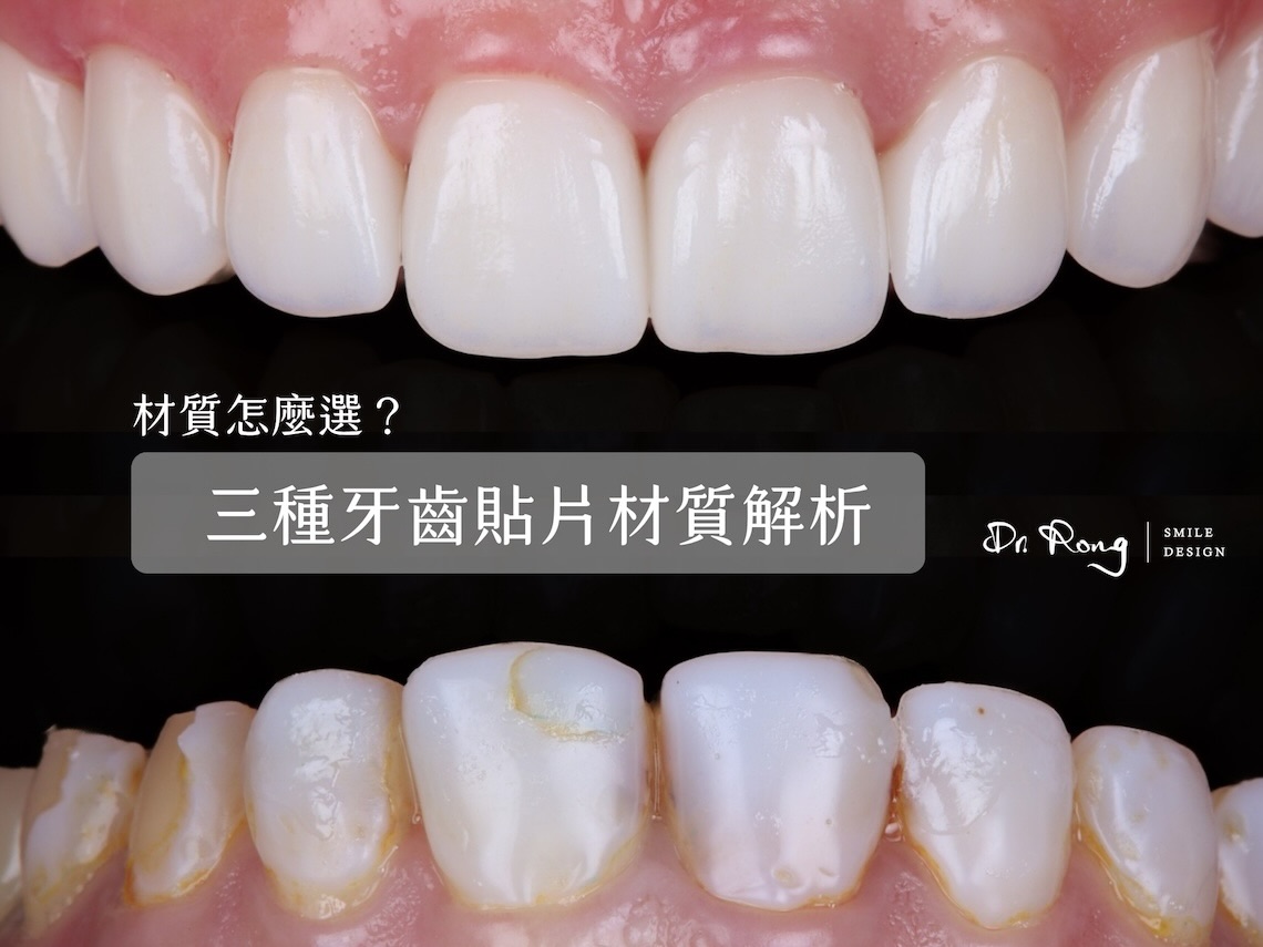 牙齒貼片材質-陶瓷貼片-樹脂貼片-二氧化鋯貼片-推薦-台北-許家榕醫師