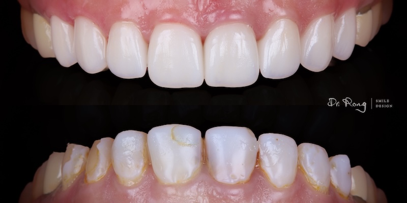 樹脂貼片失敗與重做陶瓷貼片的對比圖：下半部為樹脂貼片破損脫落，上半部為成功重建的玻璃陶瓷貼片修復結果，色澤通透、貼合自然