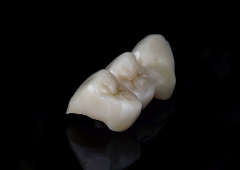 全鋯冠牙橋示意圖，具高硬度、壽命長，常用於後牙修復