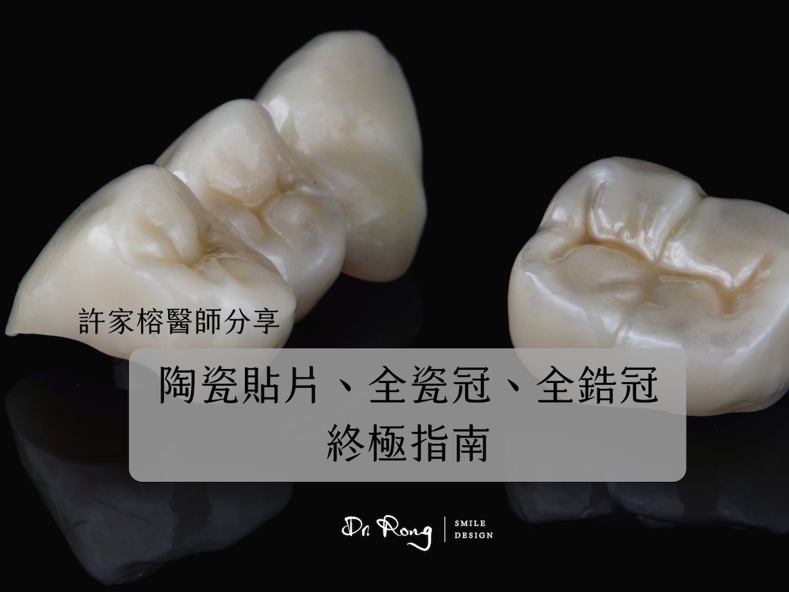 陶瓷貼片-全瓷冠-全鋯冠-壽命-費用-優缺點-推薦-台北-許家榕醫師