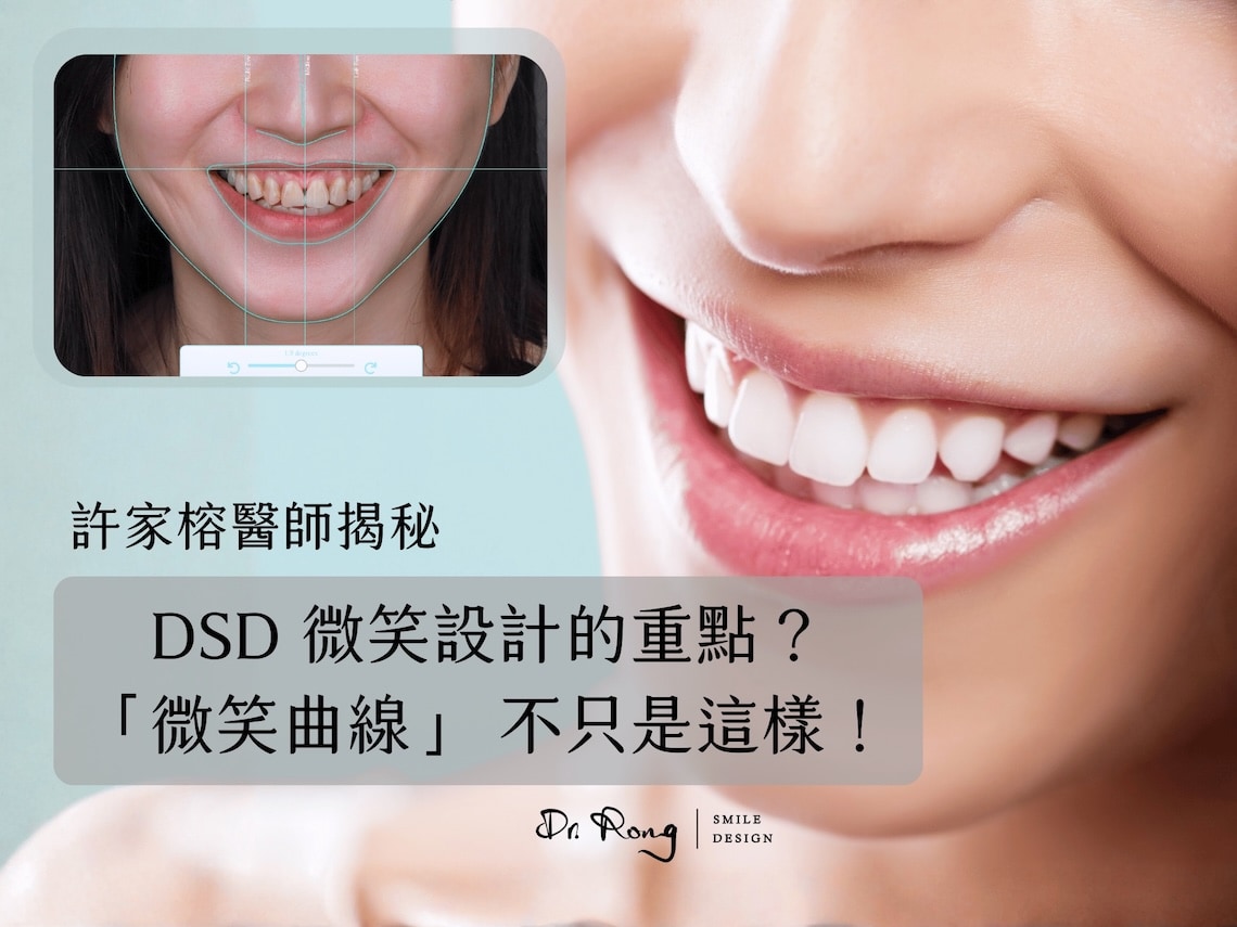 DSD數位微笑設計-台北陶瓷貼片-推薦牙醫-許家榕醫師-2026