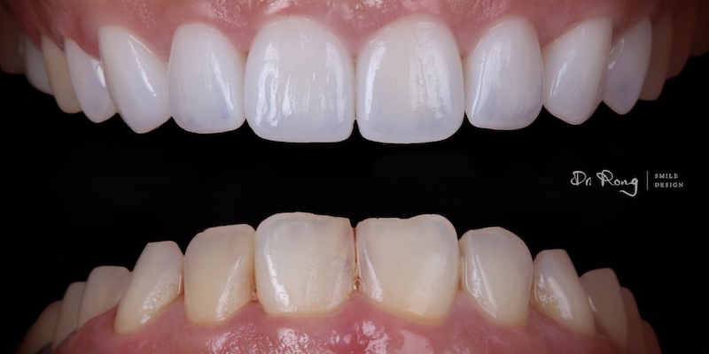 上排牙齒治療前後對比案例,呈現切端縫隙細節的臨床設計差異
