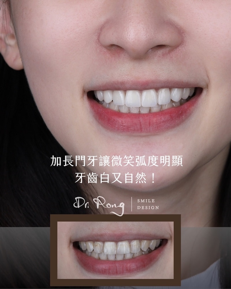 透過加長門牙調整微笑曲線的案例笑容前後對比圖