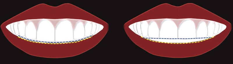 門牙與虎牙長度比例影響微笑弧線的示意比較圖