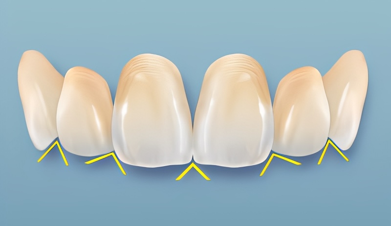 切端三角縫隙示意圖,顯示牙齒切端間的自然角度變化