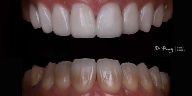 輕中度四環黴素牙齒治療前後對比照，治療前可見牙齒表面黃褐色條紋，貼片治療後遮蓋染色痕跡並美白齒色，提升微笑曲線美感